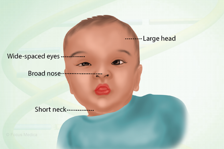 What Is Noonan Syndrome?